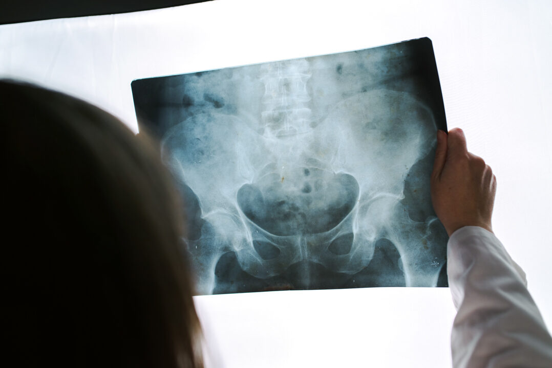 Female doctor examining pelvis x-ray in hospital office