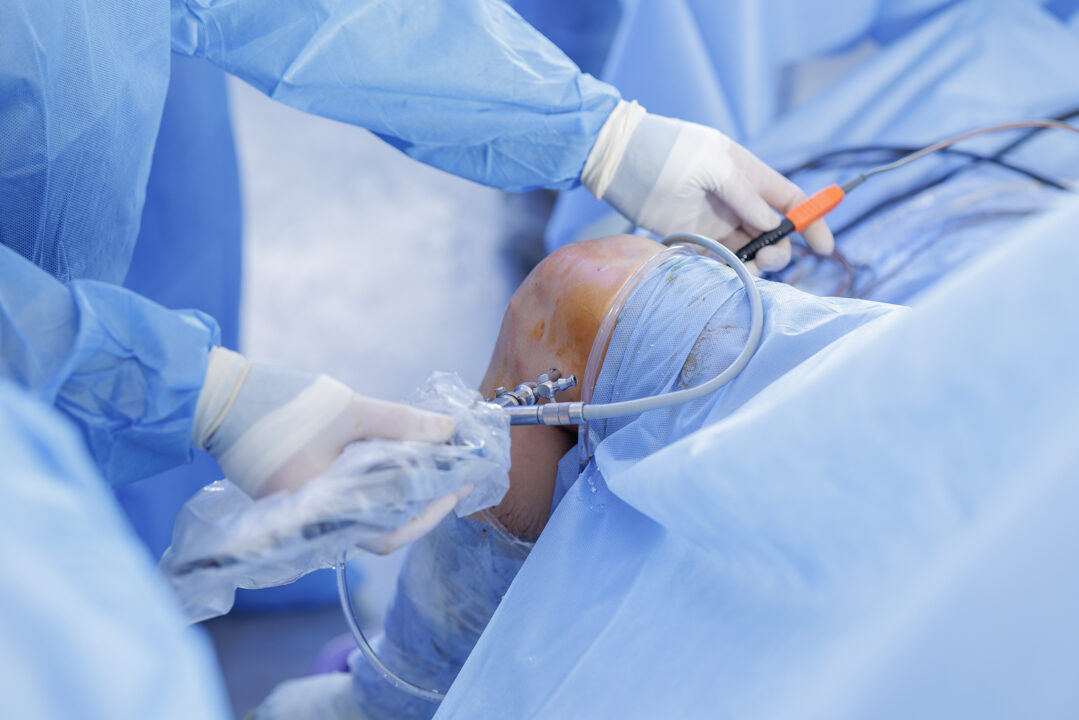 Knee arthroscopy with PCL reconstruction using arthroscope in st
