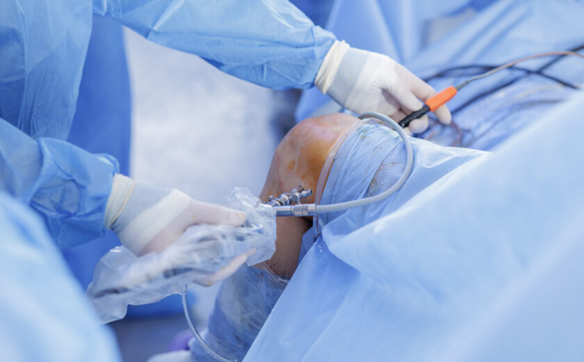 Knee arthroscopy with PCL reconstruction using arthroscope in st