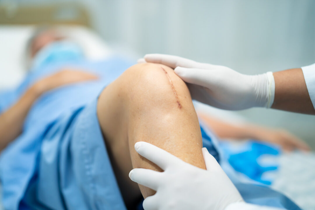 asian-elderly-woman-patient-show-her-scars-surgica-2026-03-20-03-27-03-utc