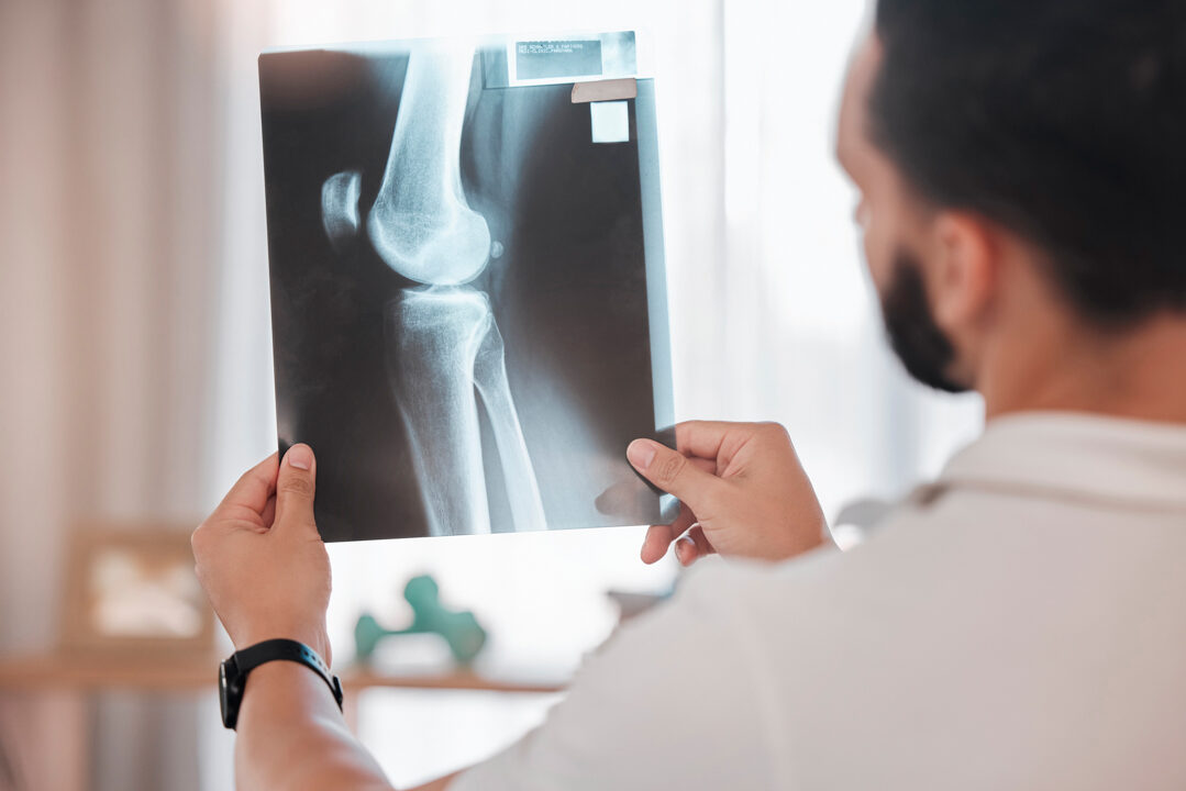 Health, x ray and physiotherapy, man physiotherapist check medic